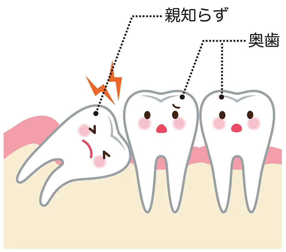 親知らずが原因で起きる後戻り