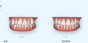 「iTero(アイテロ)」を使って治療後の歯並びを「治療前に確認」できる！