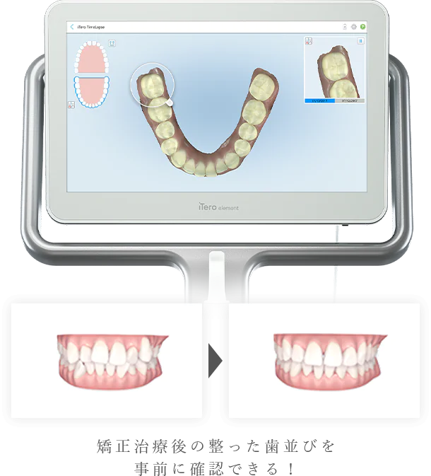 口腔内3Dスキャナー iTero element（アイテロ）導入でより快適に