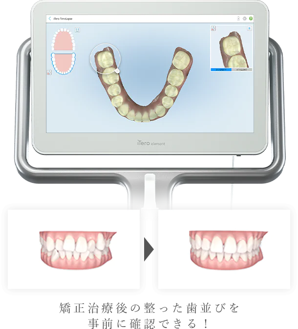 口腔内3Dスキャナー iTero element（アイテロ）導入でより快適に